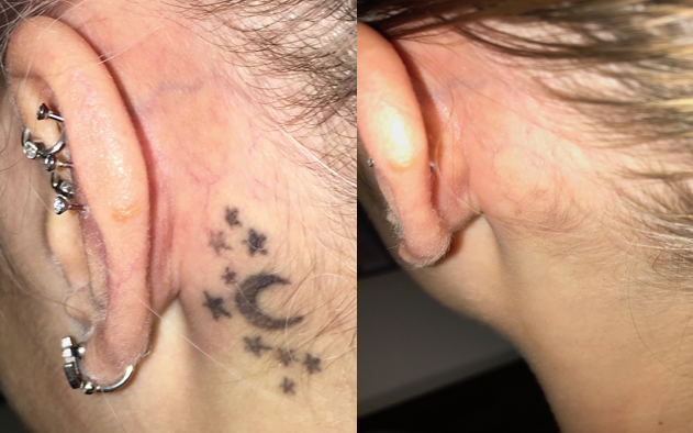 Girl with unwanted tattoo behind her left ear
