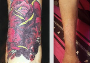 A difficult to remove lower arm multi coloured cover up tattoo, look at how clean the arm is after treatment
