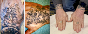 Hand tattoos removed using our Pico Laser