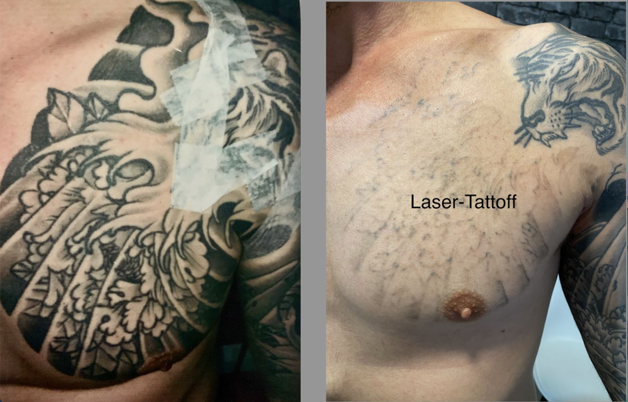 Tattoo Removal Sydney | Best Tattoo Removal Sydney | Laser Tattoff
